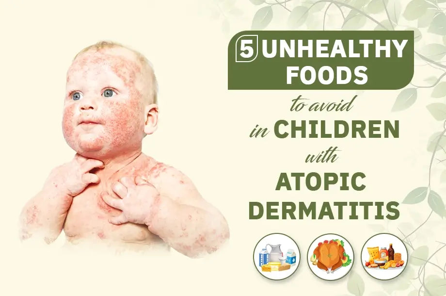 5 Unhealthy Foods To Avoid In Children With Atopic Dermatitis