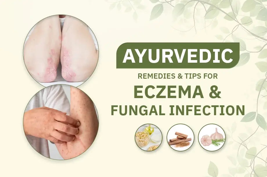 Ayurvedic Remedies and Tips For Eczema And Fungal Infections