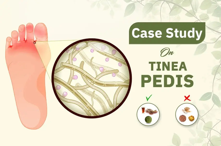 A case study on successful Treatment of Fungal Infection (Tinea Pedis)