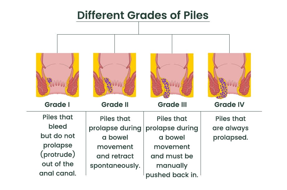 different grades of piles